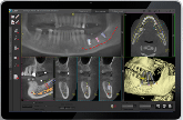 3D Conebeam Image for Dental Implants